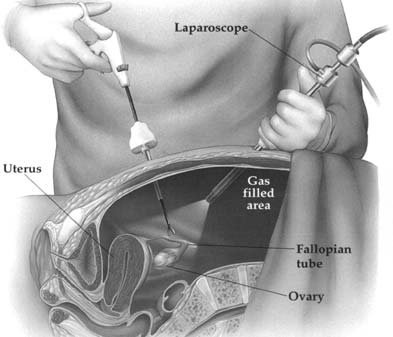 Laparoscopie standard : une seule caméra, un champ de vision étroit
