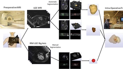 New Method CMR-Guided Endomyocardial Biopsy in Suspicion Context of Isolated Cardiac Sarcoidosis featured image