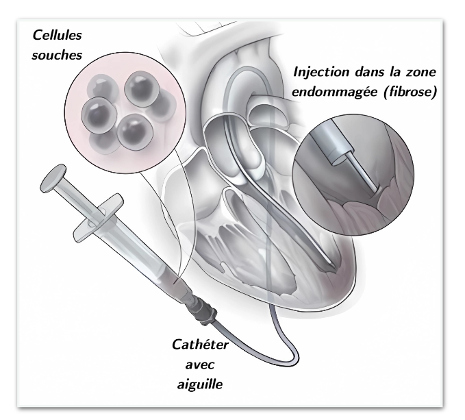Re-injecting cells in the right place: the precision of the gesture determines the therapy&rsquo;s effectiveness.