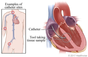 Endomyocardial biopsy: sampling a piece of cardiac tissue, where the lesion is located.