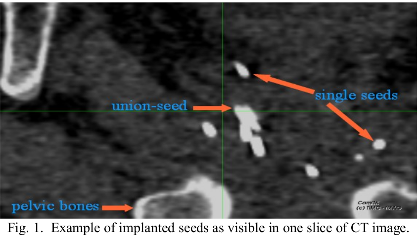 Implanted seeds as visible in a CT slice: single seeds, clustered seeds, and pelvic bones