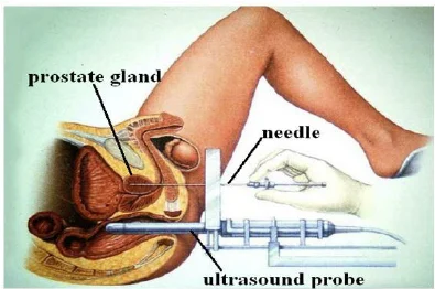 Transperineal implantation guided by ultrasound — clinical context