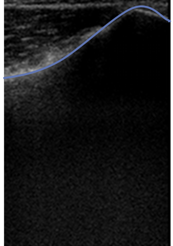 Segmentation of the bone surface in an ultrasound image
