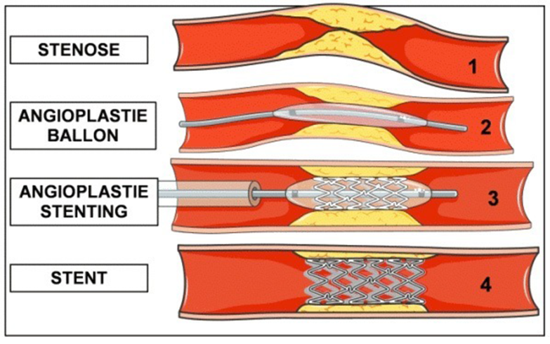 Endovascular revascularization techniques: angioplasty and stenting (fig. 1.9, M. Roux thesis).
