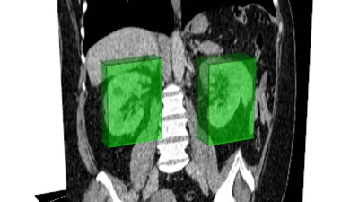 Automatically locating organs in CT images featured image